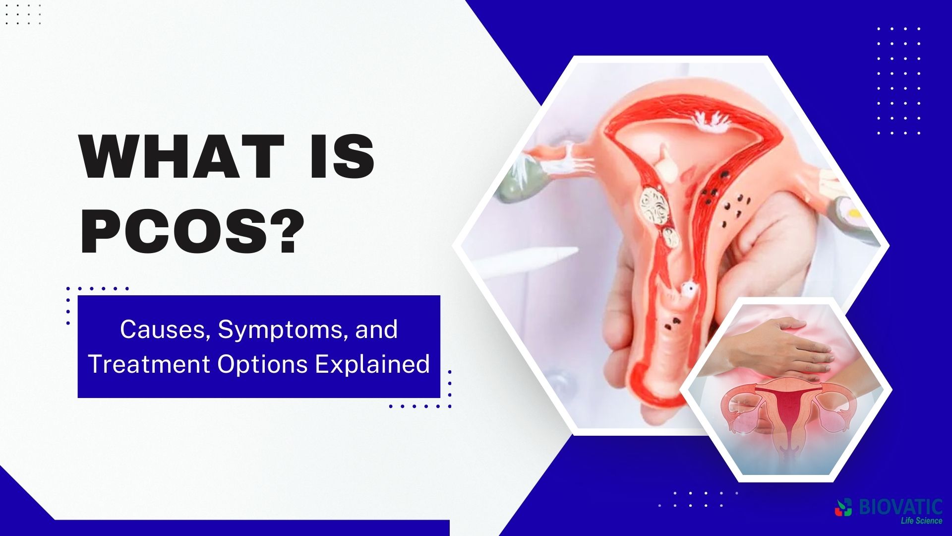 What is PCOS? Causes, Symptoms, and Treatment Options Explained